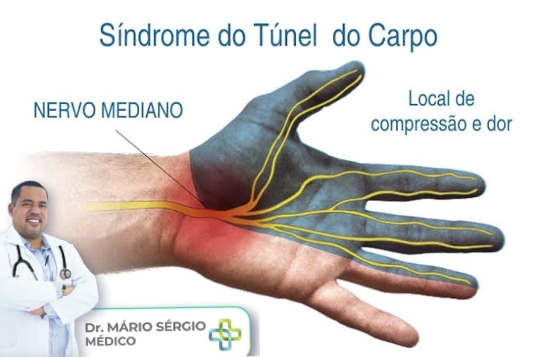 Dor no punho e formigamento na mão? Pode ser túnel do carpo